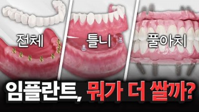 임플란트 가격 비교 정보, 임플란트 종류 및 가격 비용 정보, 전체임플란트 vs 임플란트 틀니 vs 풀아치 임플란트 비교 추천 정보 (남양주 디지털프라임 치과)