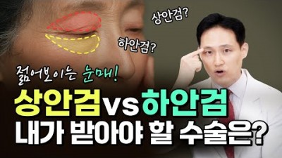 상안검거상술, 하안검거상술, 중년 눈매 교정, 처진 눈 늘어진 눈 상안검 하안검 장단점 및 주의점
